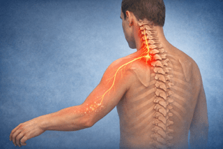 Pinched Nerves in the Neck 